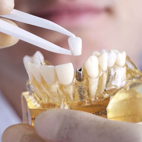 A dental mold demonstrating how dental implants work