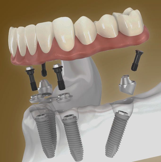 All-on-4 components