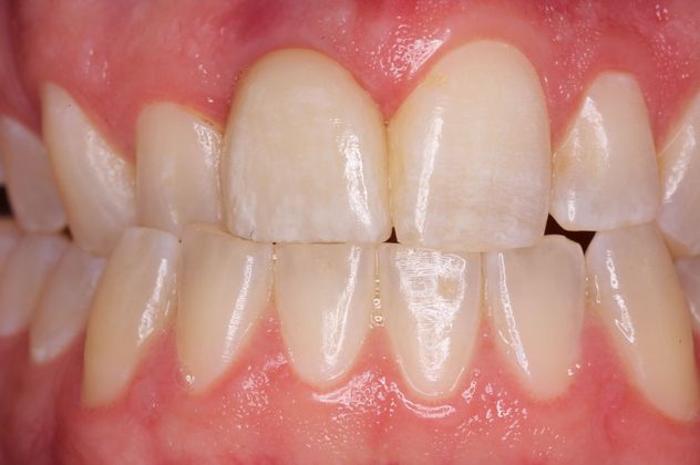 Patient after implant-supported restoration placement